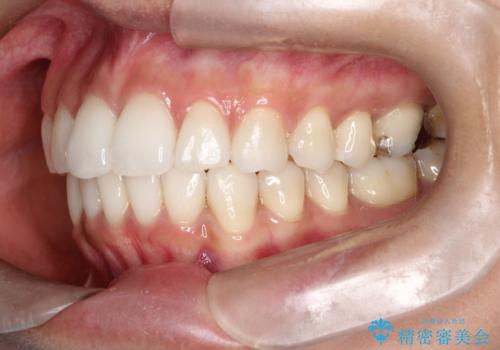 【インビザライン】前歯の凸凹をIPRで改善の治療後