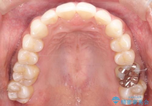 【インビザライン】前歯の凸凹をIPRで改善の治療後