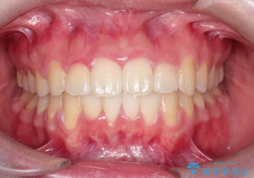【インビザライン】前歯の凸凹を非抜歯で治療の症例 治療後