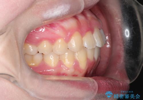 【インビザライン】前歯の凸凹を非抜歯で治療の治療後