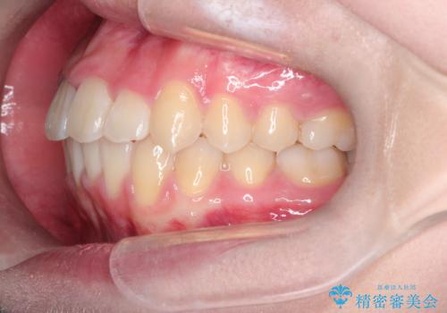 【インビザライン】前歯の凸凹を非抜歯で治療の治療後