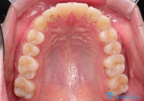 【インビザライン】前歯の凸凹を非抜歯で治療の治療後