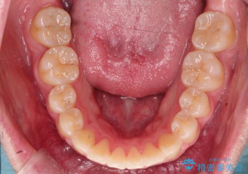 【インビザライン】前歯の凸凹を非抜歯で治療の治療後