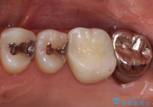 【根管治療】未処置根管を有した歯の再根管治療の症例 治療後