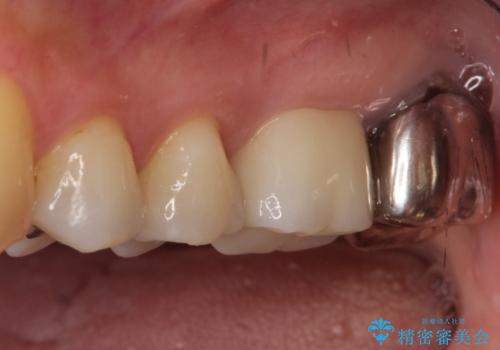 【根管治療】未処置根管を有した歯の再根管治療の治療後