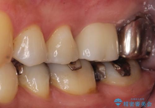 【根管治療】未処置根管を有した歯の再根管治療の治療後