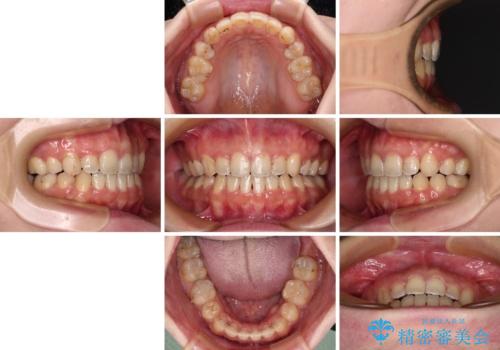 八重歯を抜歯矯正でスッキリと メタルブラケットでの矯正治療の治療後