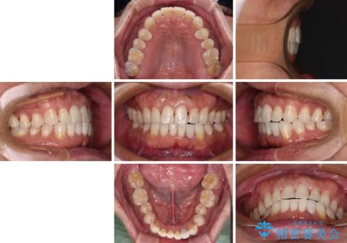 内側にある歯が干渉する 上顎前歯の部分矯正の治療後