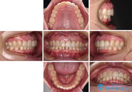 前歯のインプラント治療　折角なので矯正治療できれいな歯並びにの治療後