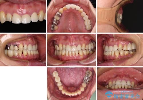 反対咬合や欠損を治療したい インビザライン矯正とオールセラミックブリッジの治療後