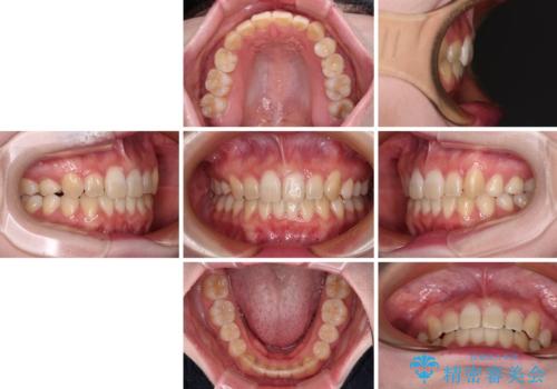 ディープバイトをインビザライン矯正で改善の治療後