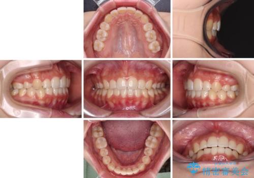 【モニター】八重歯とデコボコをスッキリきれいに ワイヤー装置での抜歯矯正の治療後