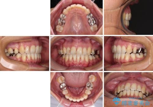 八重歯で口元が膨れている ワイヤー装置での抜歯矯正の治療後