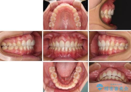 前歯の出っ歯と口の閉じにくさが気になる 目立たないワイヤー装置での抜歯矯正の治療後