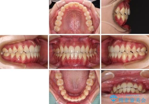 受け口と開咬を急速拡大装置とワイヤー装置で改善の治療後