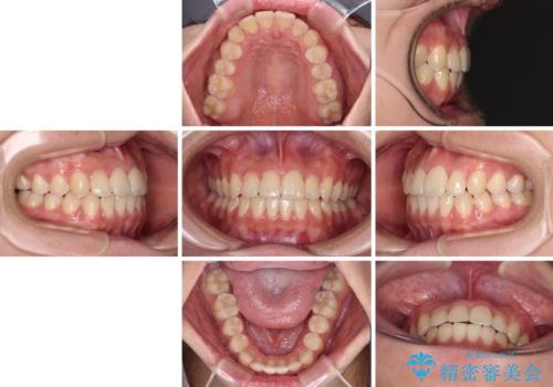 前歯のクロスバイトを短期間で解消 目立たないワイヤー矯正の治療後