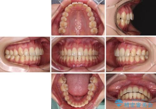 【モニター】飛び出した上顎前歯のワイヤー矯正で改善の治療後