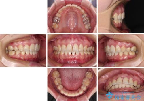 出っ歯による口の閉じにくさを治したい　ワイヤー装置を用いた抜歯矯正の治療後