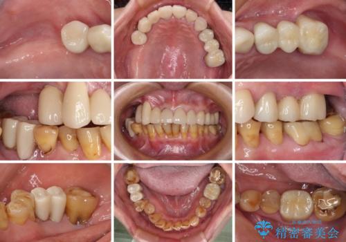 治療途中で放置してしまった前歯　オールセラミッククラウンによる補綴治療の治療後