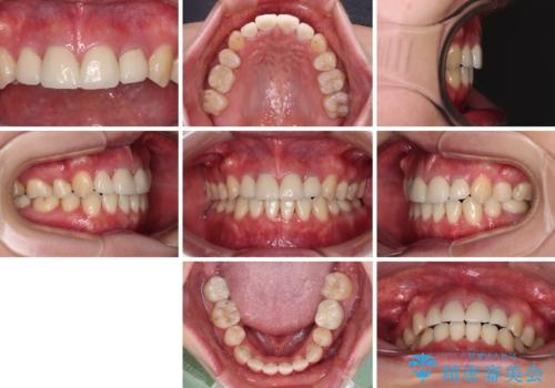 八重歯と開咬を治したい 目立たないハーフリンガル矯正の治療後