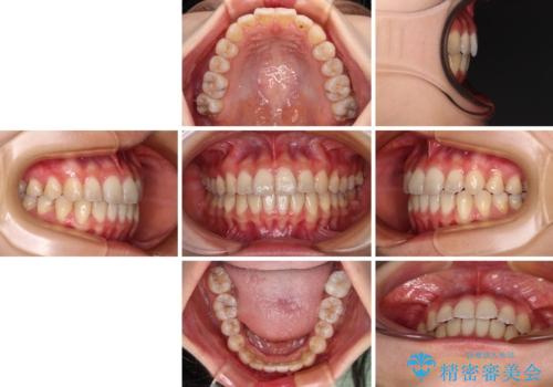 前歯のクロスバイト ワイヤー装置を併用したインビザライン矯正の治療後