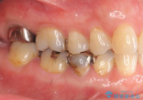口腔内をメタルフリーにしたいの治療前