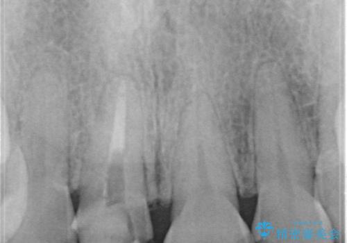 【オールセラミッククラウン】他院で入れた被せものがすぐとれるの治療前