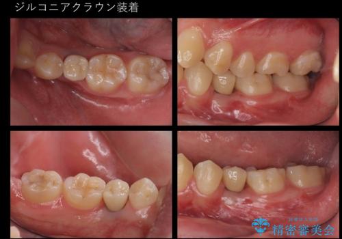 生まれつき歯が少ない 20代でインプラント治療の症例 治療後