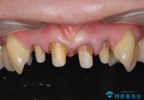 前歯をきれいにしたいの治療中