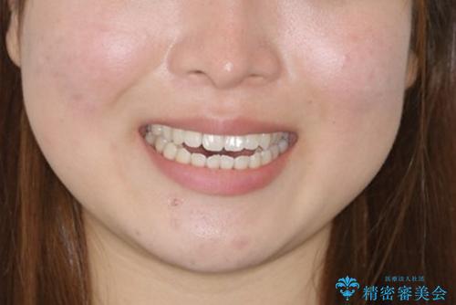 前歯で噛めない:オープンバイト(開咬)を非抜歯インビザラインで治療の治療前（顔貌）