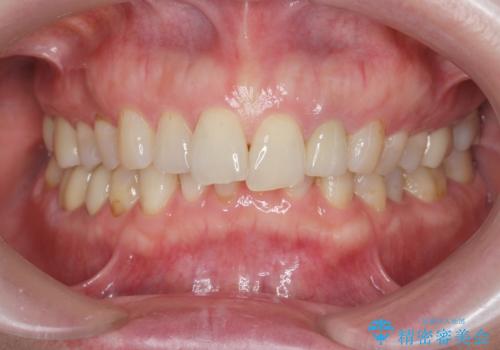 口腔内をメタルフリーにしたいの治療後