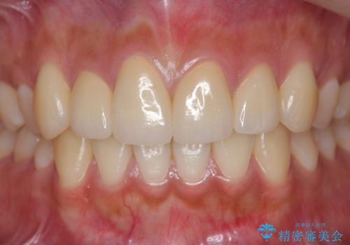 [ 前歯のセラミック治療 ]   短期間で歯並びを治したいの治療後