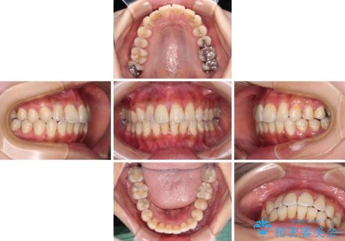 デコボコで磨きにくい前歯をスッキリと インビザライン矯正の治療中