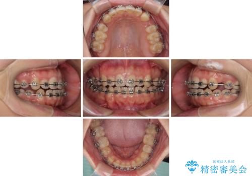 八重歯を抜歯矯正でスッキリと メタルブラケットでの矯正治療の治療中