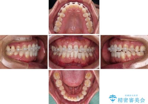 内側にある歯が干渉する　上顎前歯の部分矯正の治療中