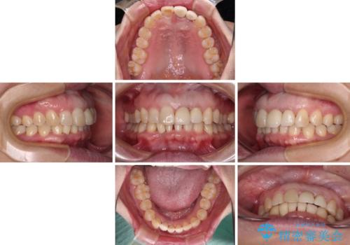 前歯のインプラント治療　折角なので矯正治療できれいな歯並びにの治療中