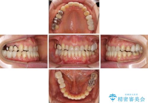 反対咬合や欠損を治療したい インビザライン矯正とオールセラミックブリッジの治療中