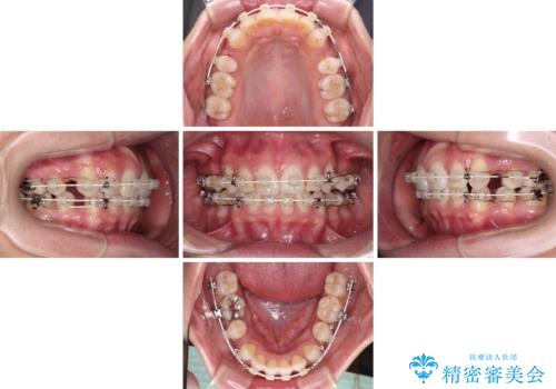 唇を閉じやすく　出っ歯の抜歯矯正の治療中