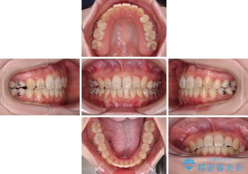 ディープバイトをインビザライン矯正で改善の治療中