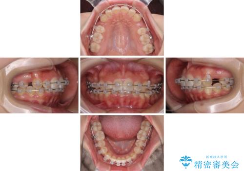 【モニター】八重歯とデコボコをスッキリきれいに ワイヤー装置での抜歯矯正の治療中
