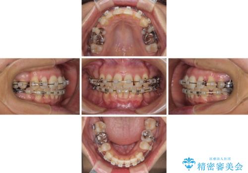 八重歯で口元が膨れている ワイヤー装置での抜歯矯正の治療中