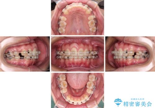 前歯の出っ歯と口の閉じにくさが気になる 目立たないワイヤー装置での抜歯矯正の治療中