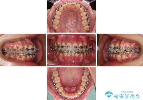 受け口と開咬を急速拡大装置とワイヤー装置で改善の治療中