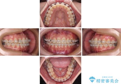 前歯のクロスバイトを短期間で解消　目立たないワイヤー矯正の治療中