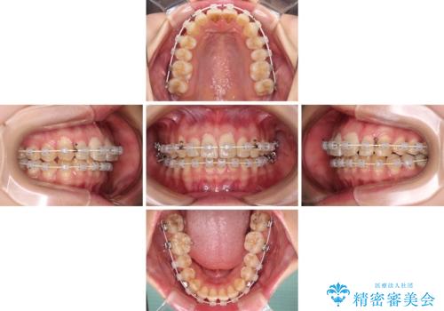 【モニター】飛び出した上顎前歯のワイヤー矯正で改善の治療中