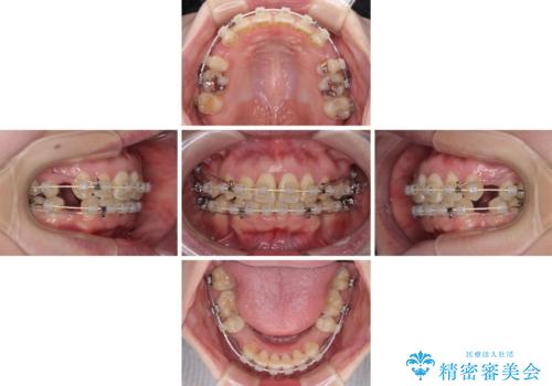 出っ歯による口の閉じにくさを治したい　ワイヤー装置を用いた抜歯矯正の治療中