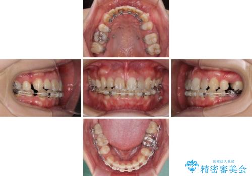 八重歯と開咬を治したい 目立たないハーフリンガル矯正の治療中