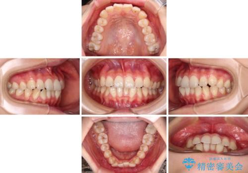 前歯のクロスバイト ワイヤー装置を併用したインビザライン矯正の治療中