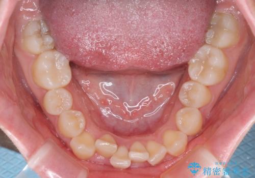【モニター】八重歯とデコボコをスッキリきれいに　ワイヤー装置での抜歯矯正の治療前