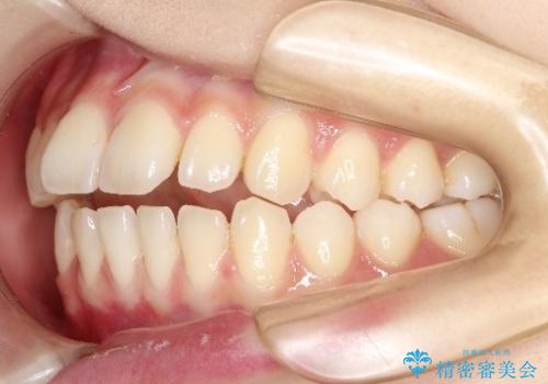 【前歯で噛めません、すきっ歯も気になります】インビザライン治療症例の治療前